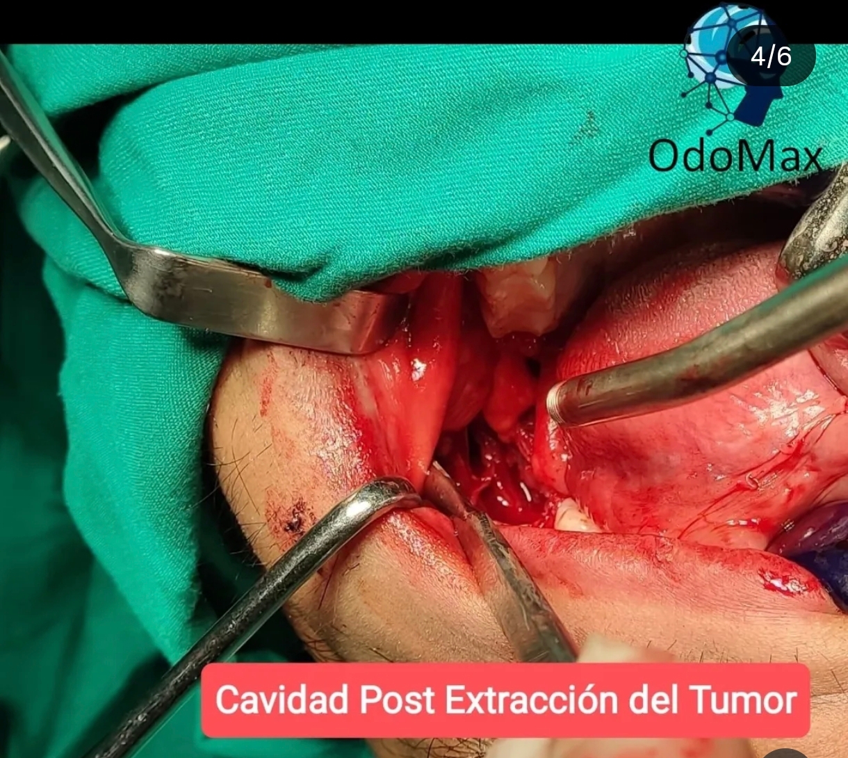 Cavidad Tumoral