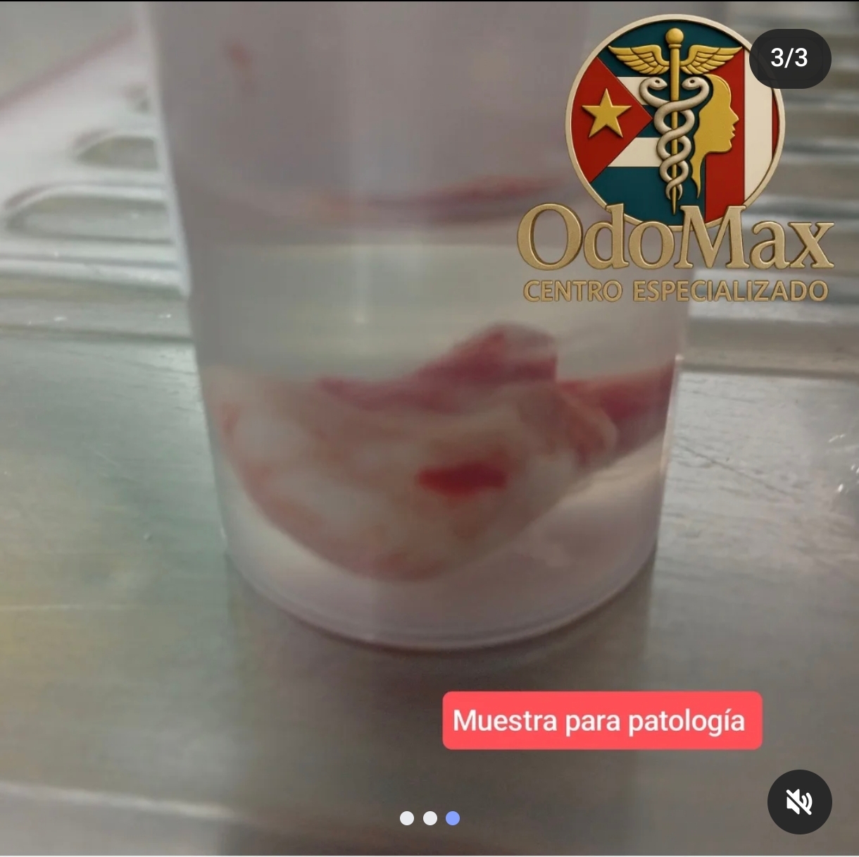 Muestra de Granuloma Piogeno