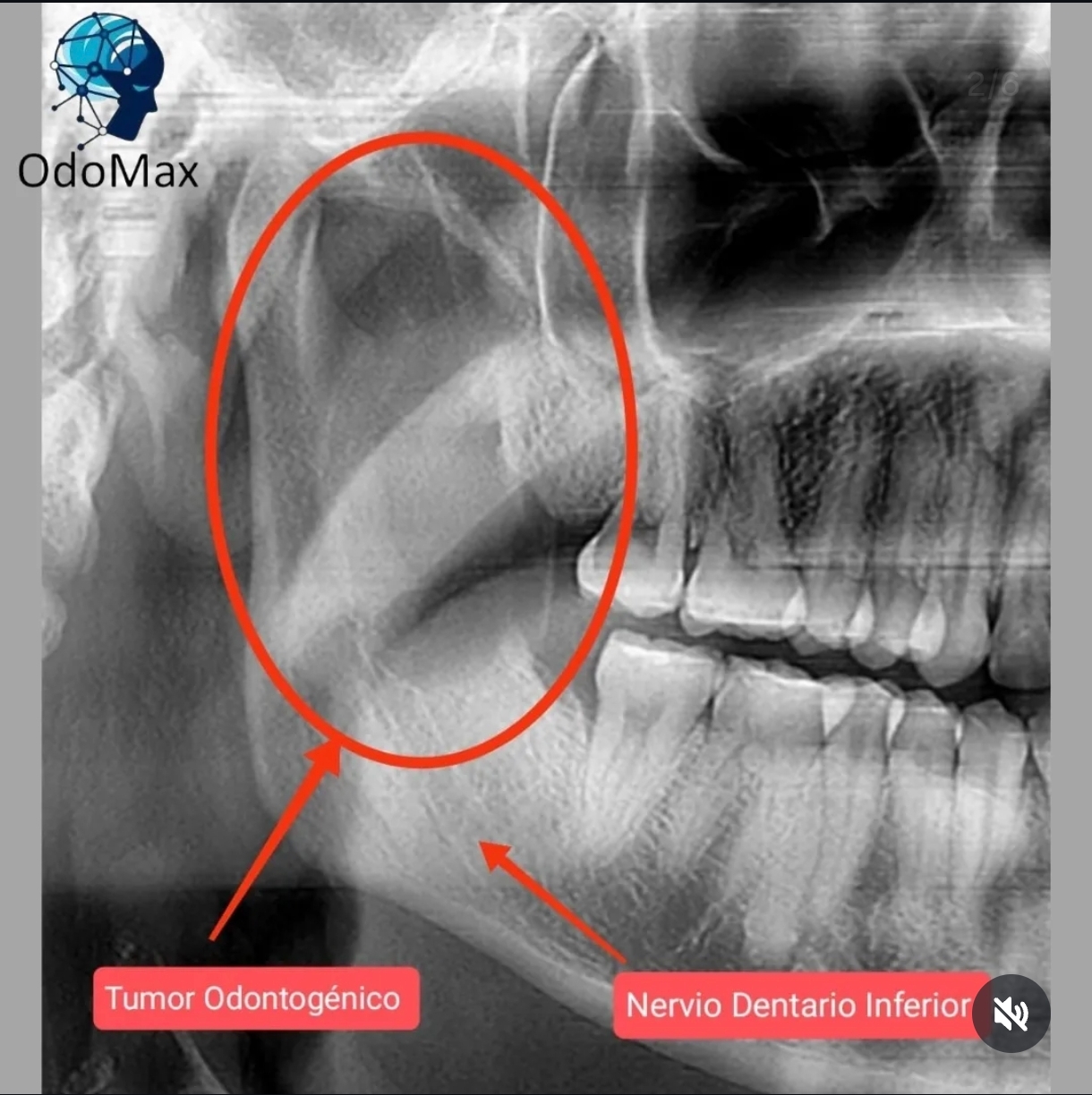 Radiografia Panoramica de Tumor odontogenico
