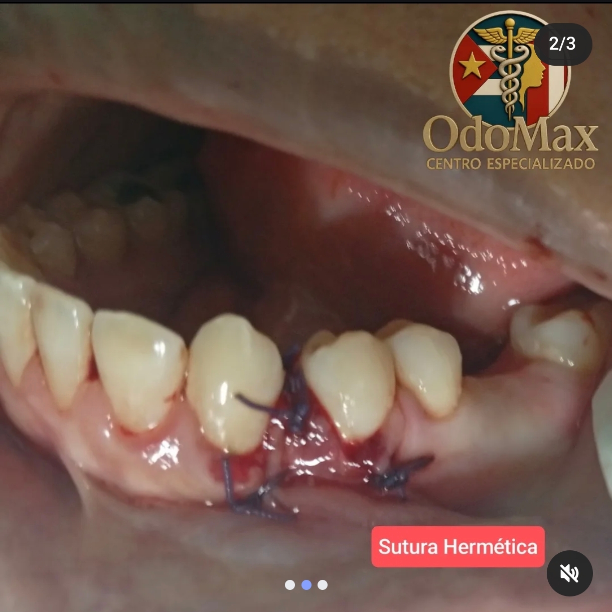 Sutura Granuloma Piogeno
