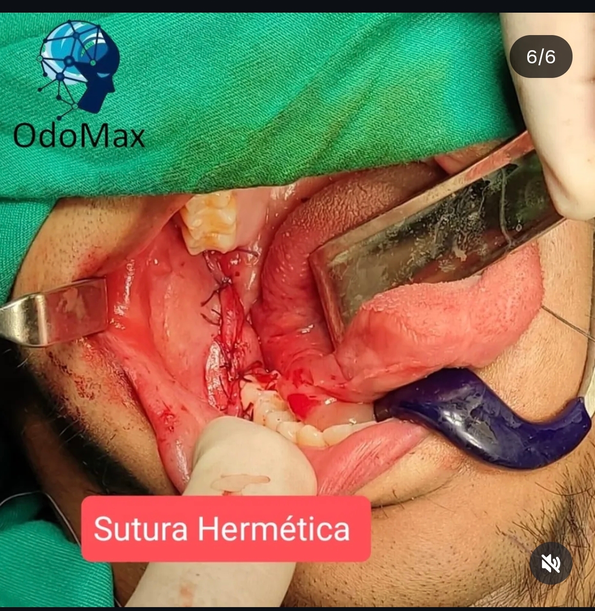 Sutura Hermetica