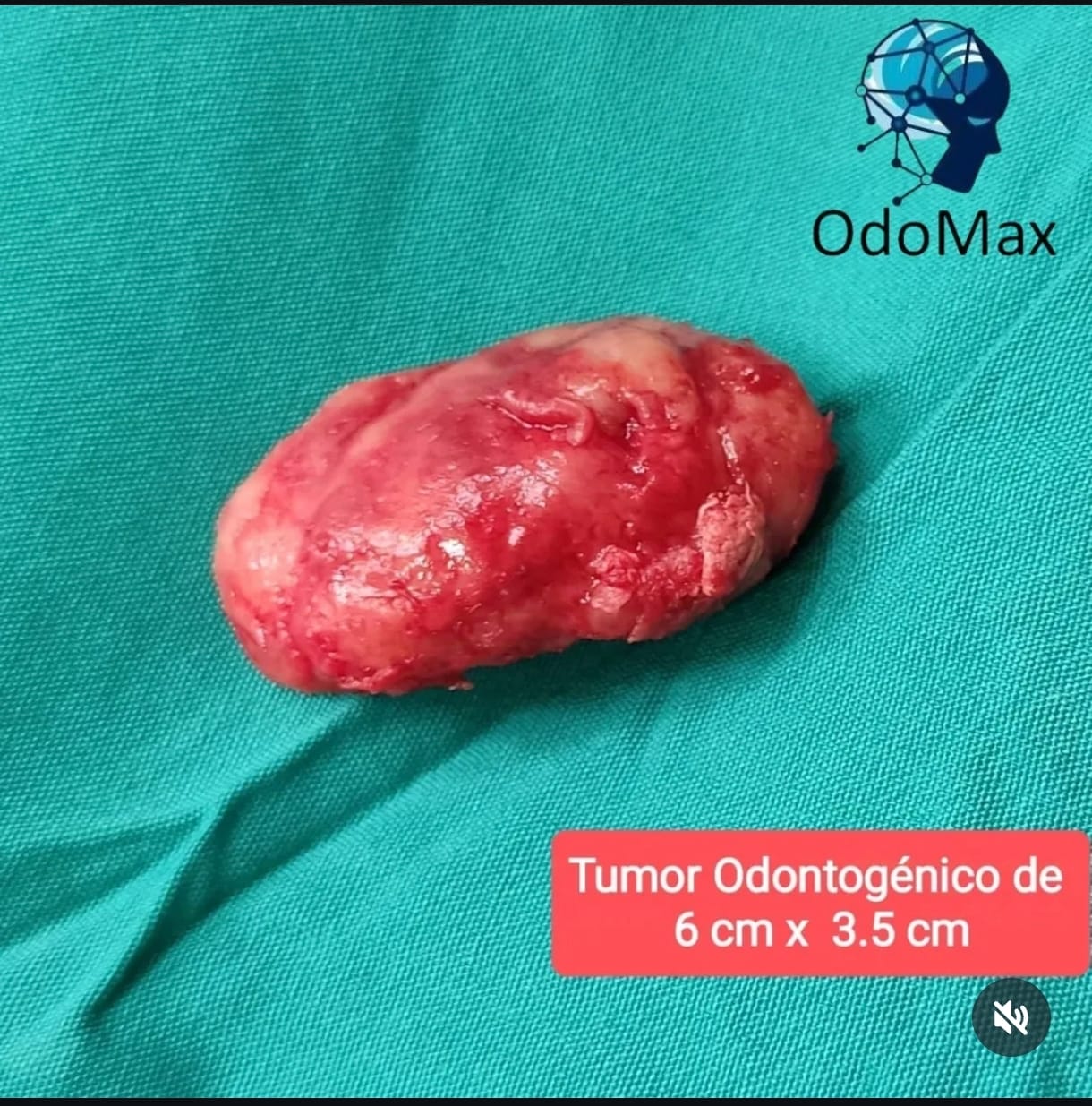 Tumor odontogenico