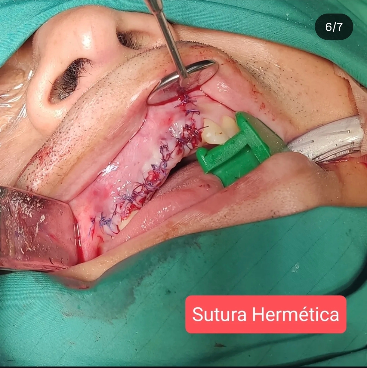 Quiste Periapical