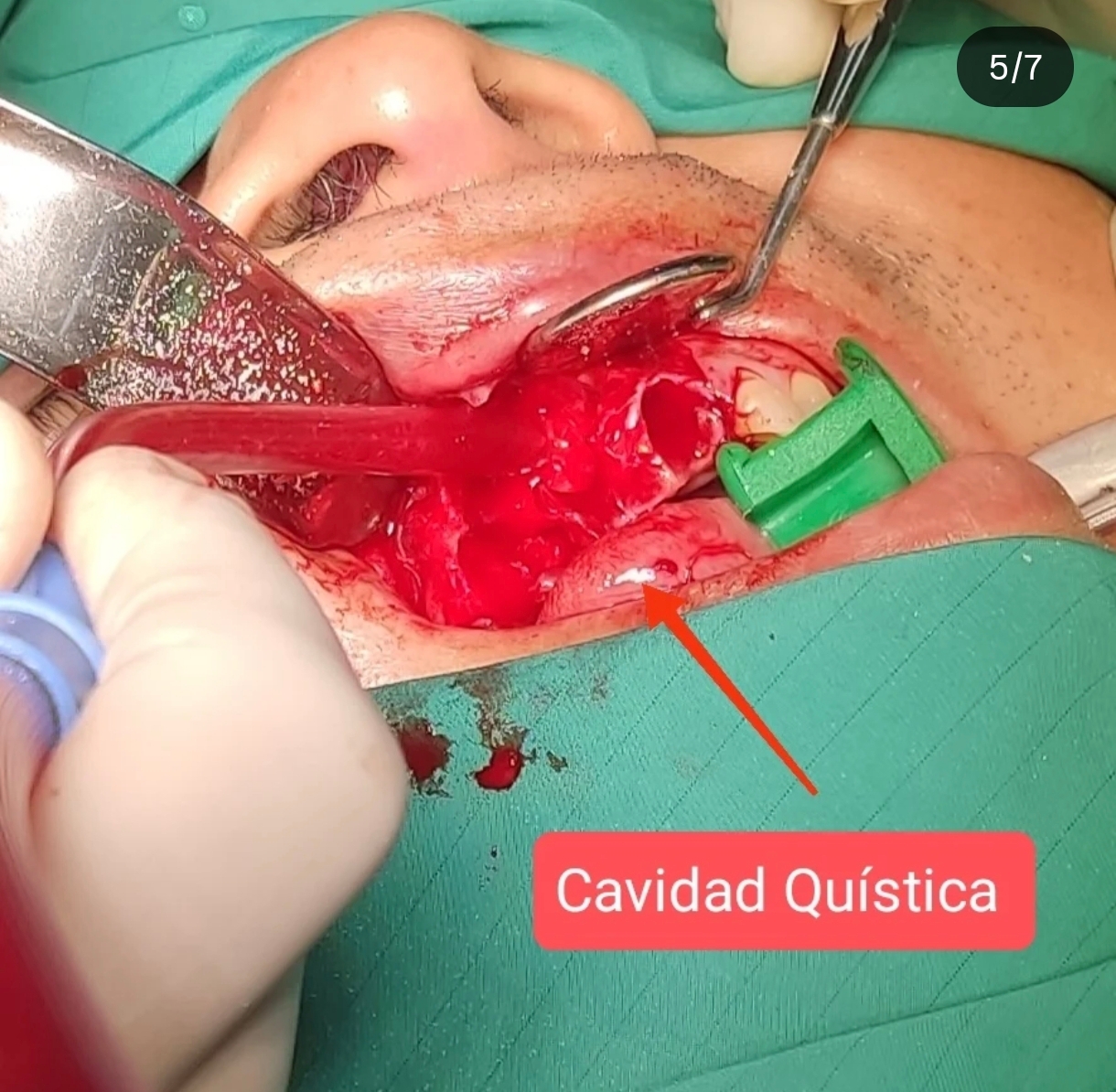 Quiste Periapical