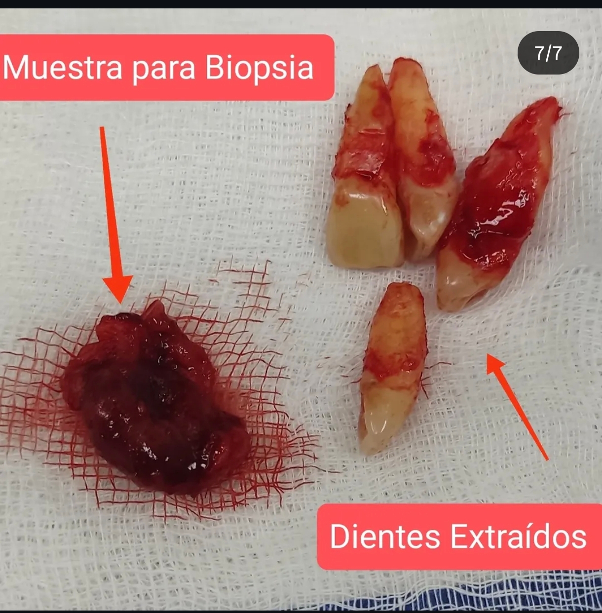 Quiste Periapical
