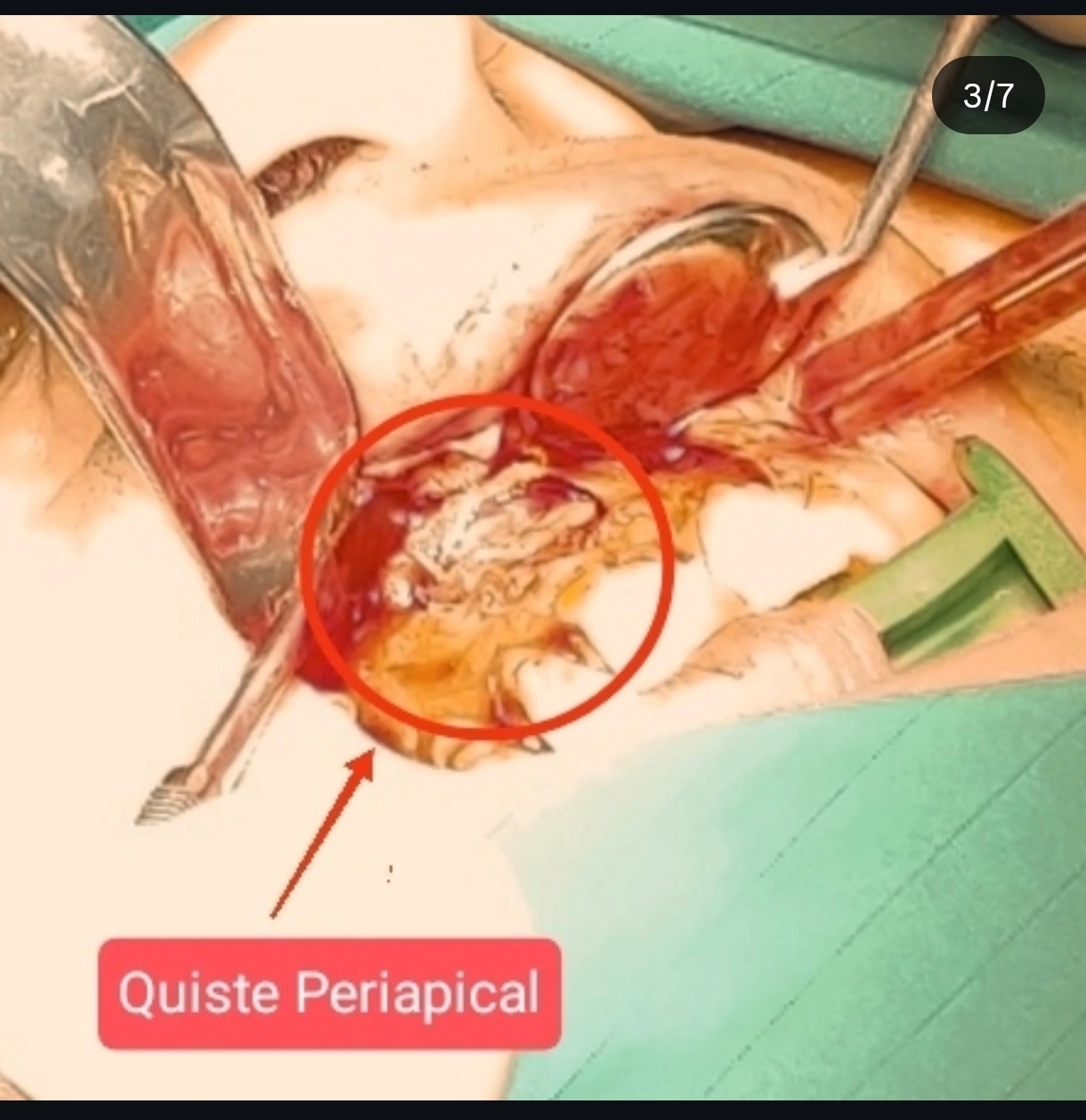 Quiste Periapical