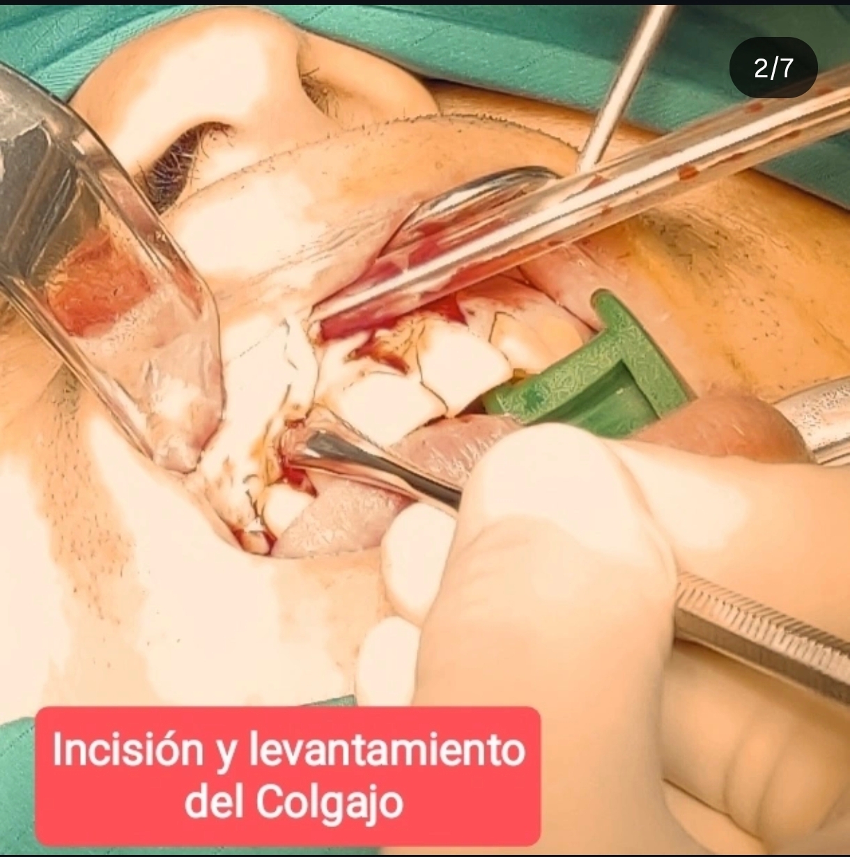 Quiste Periapical