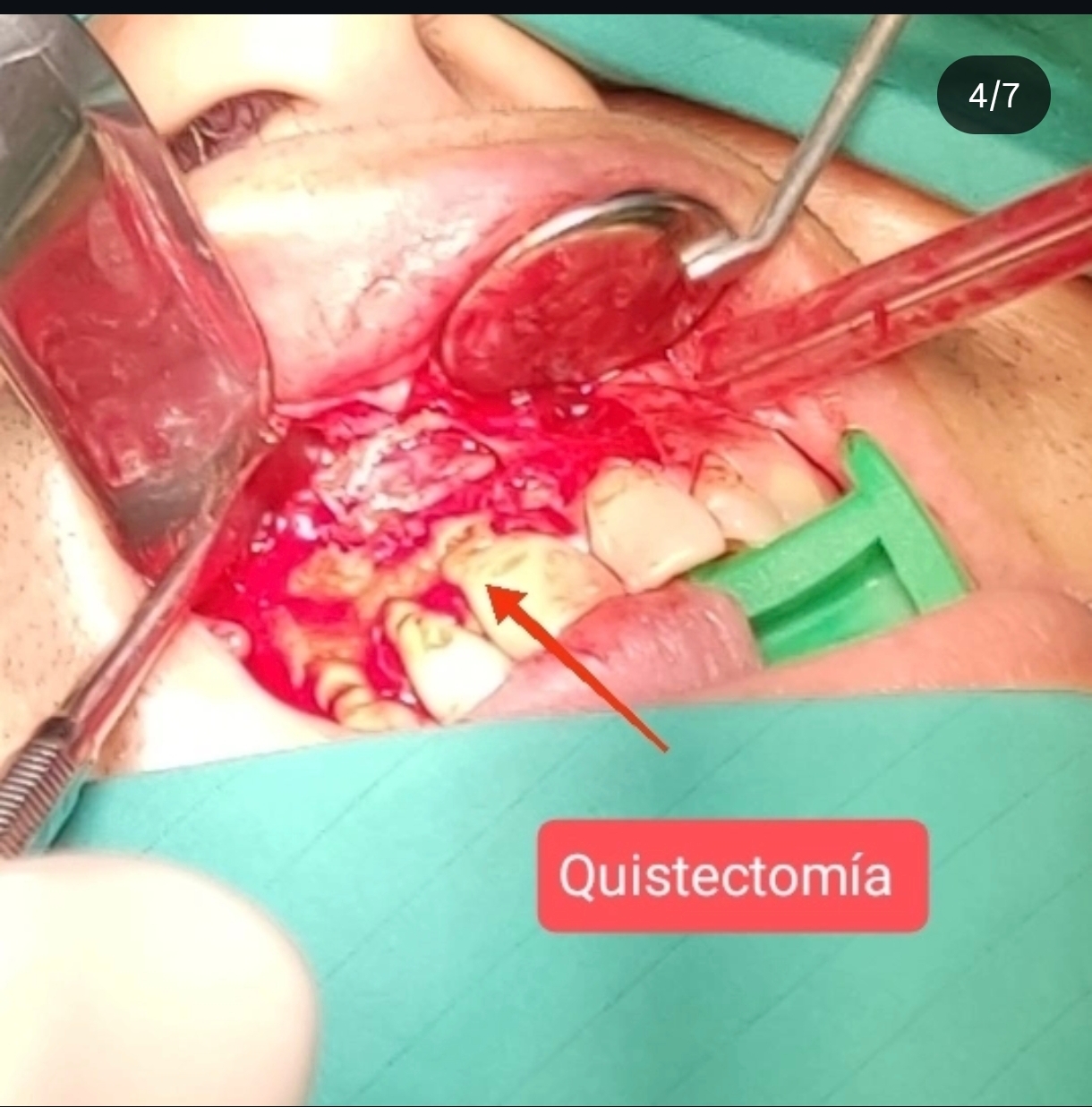 Quiste Periapical