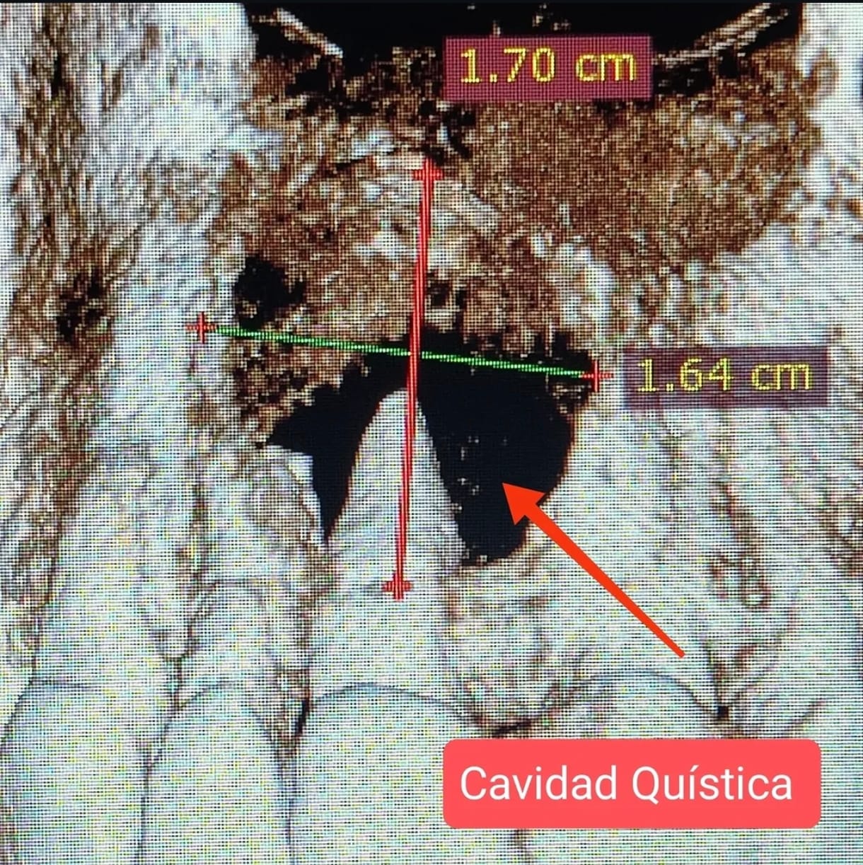 TOMOGRAFIA DE QUISTE PERIAPICAL