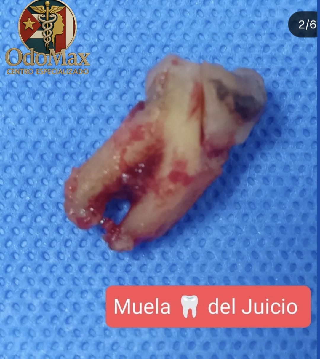 Muela del Juicio Impactada