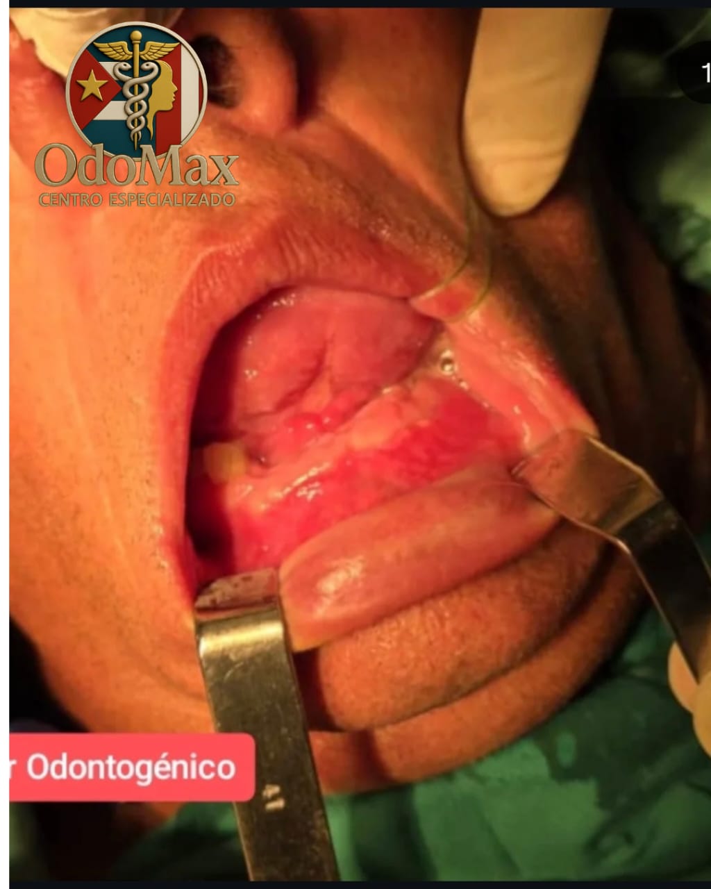 Ameloblastoma en cavidad oral