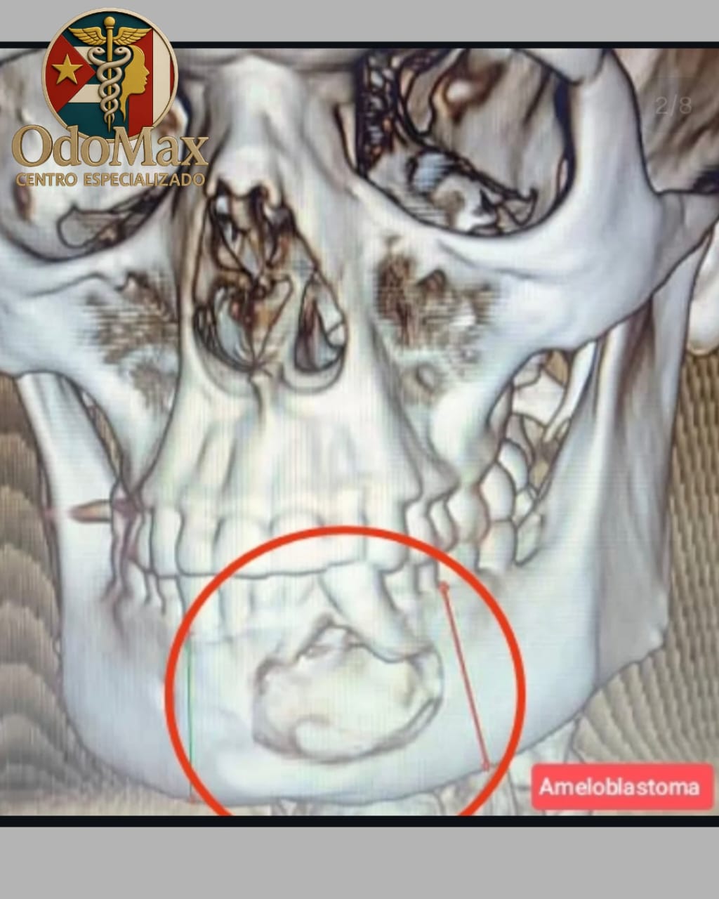 TEM de Ameloblastoma Mandibular