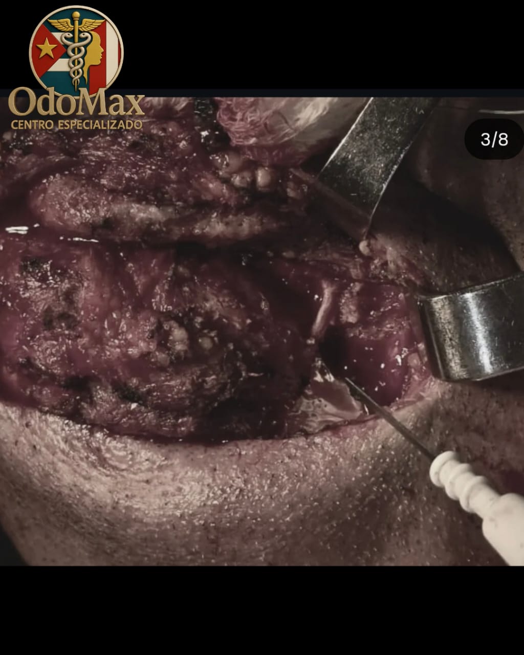 Ameloblastoma en cavidad oral