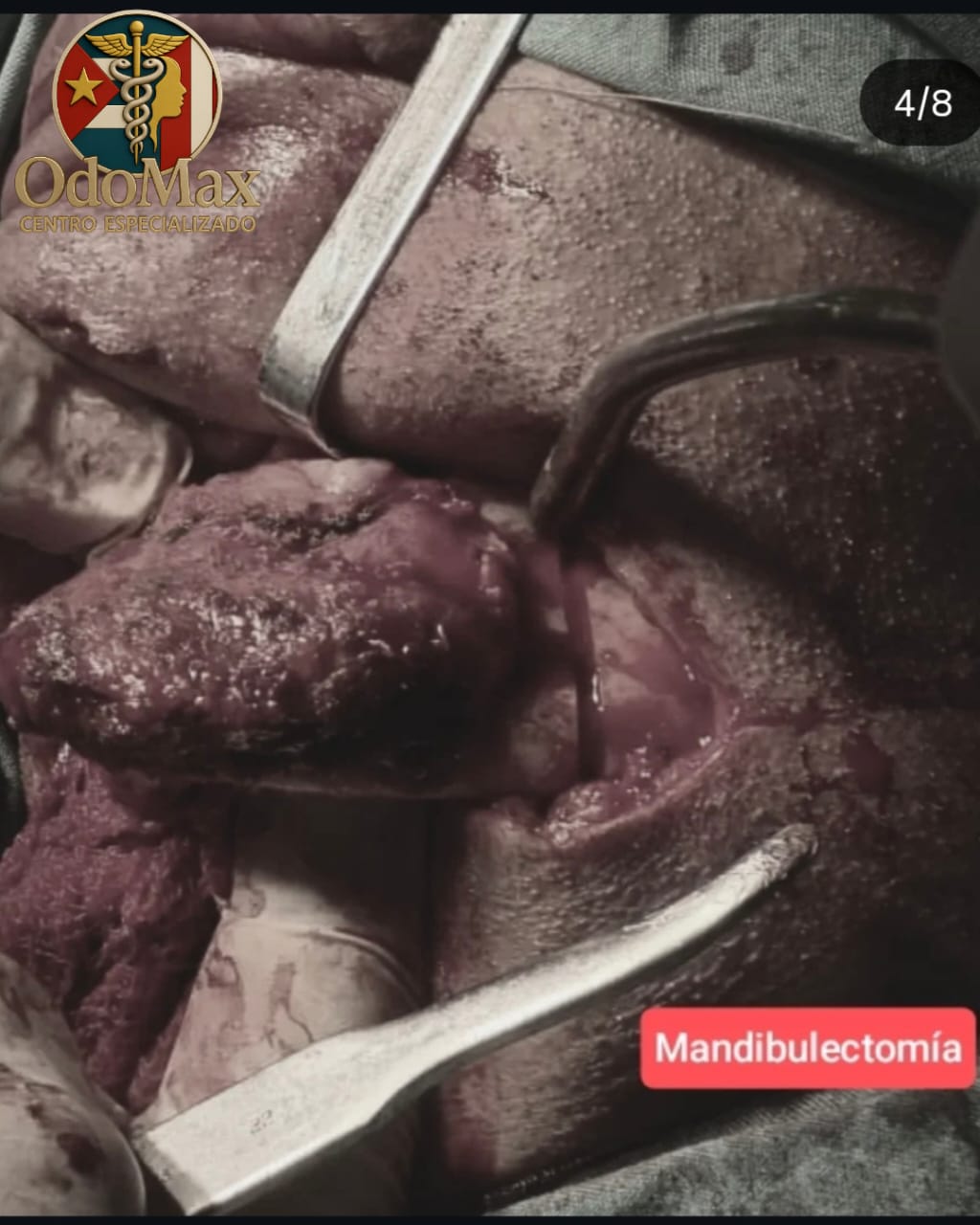 Ameloblastoma