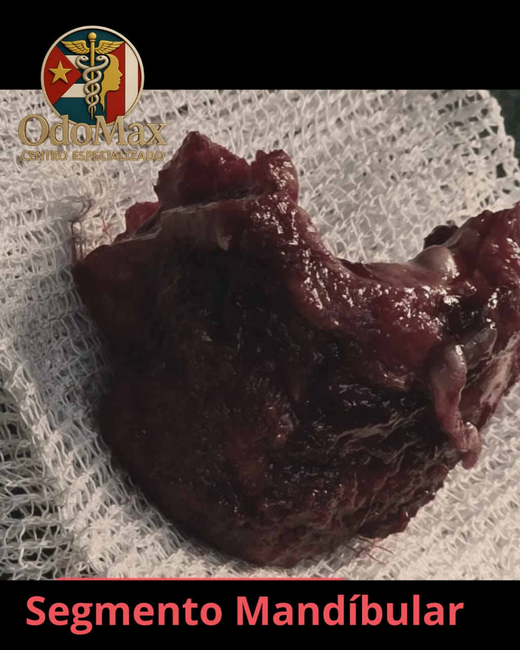 Ameloblastoma