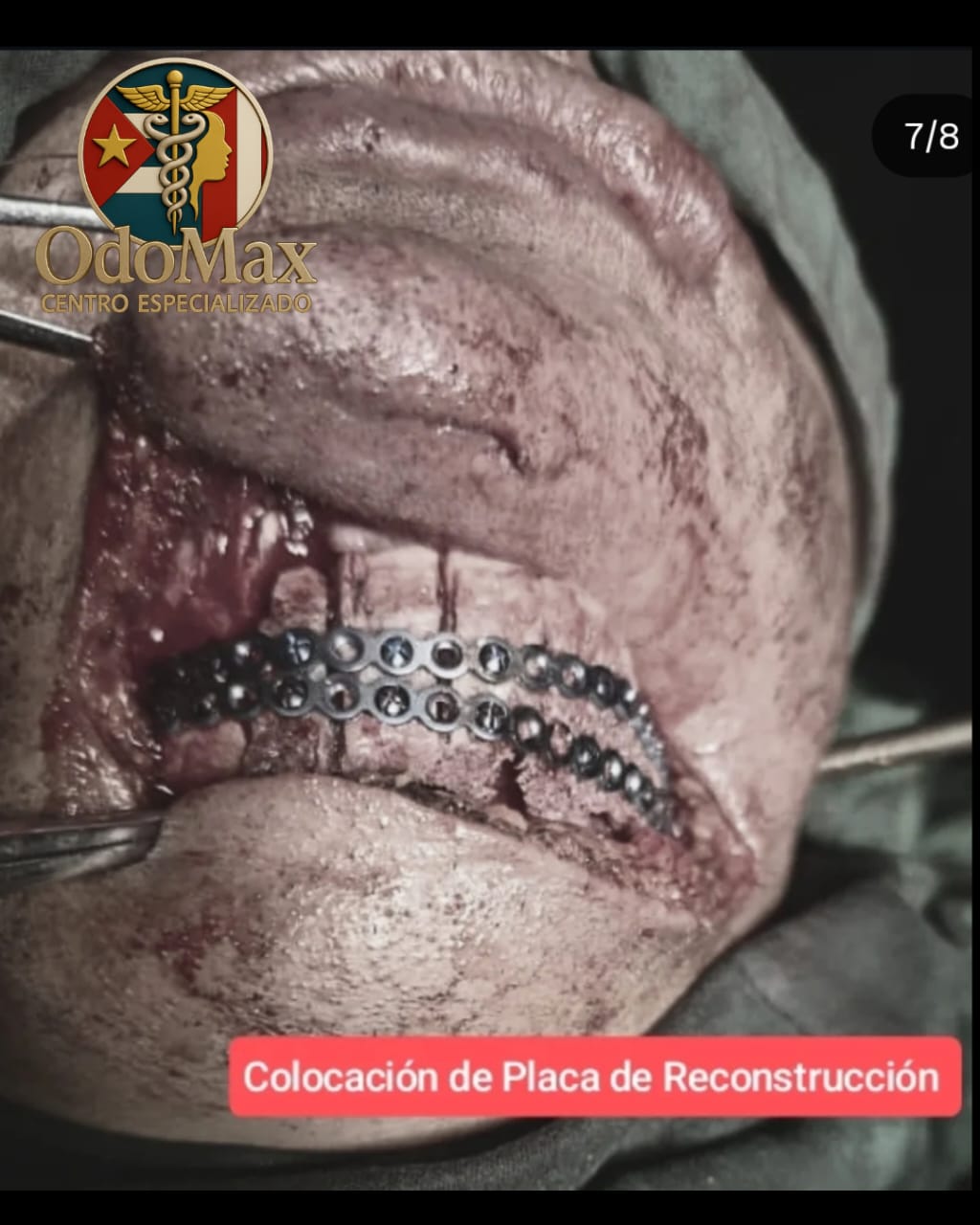 Ameloblastoma