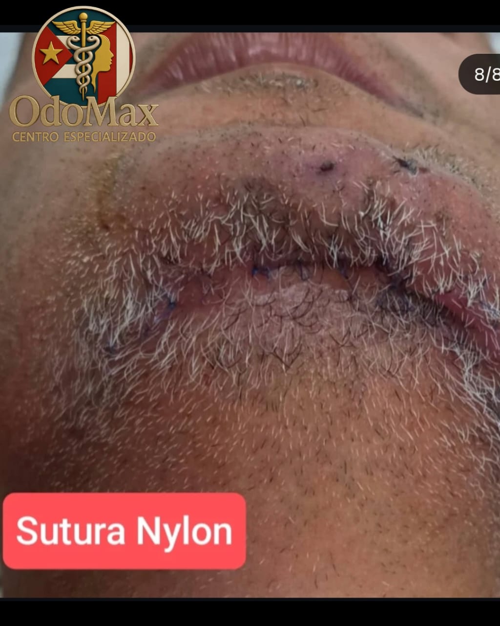 Ameloblastoma