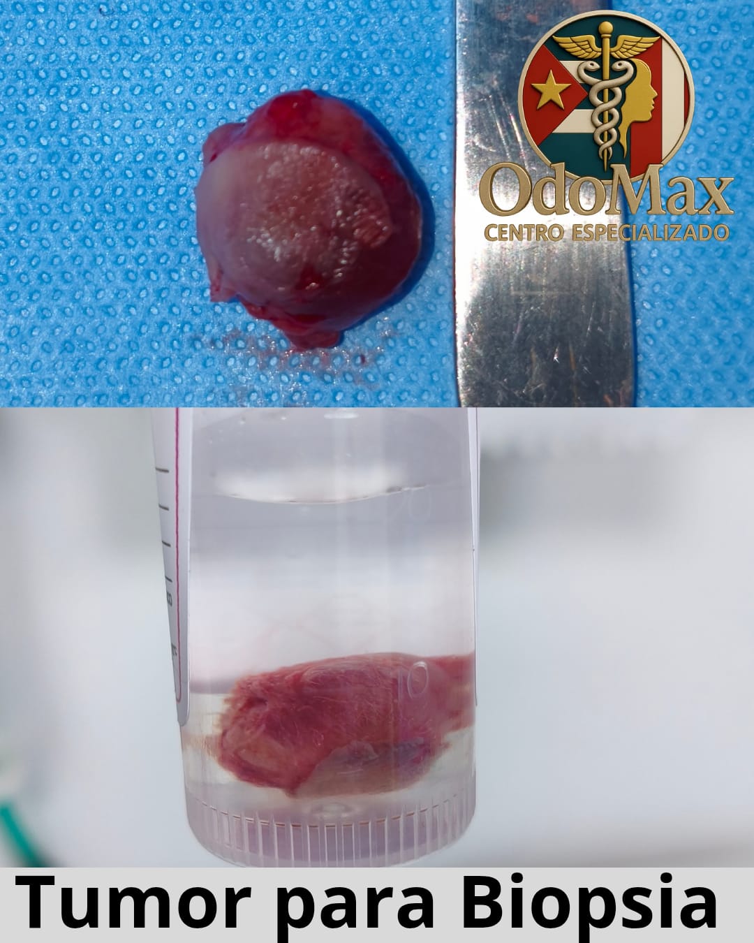 Muestra para Biopsia